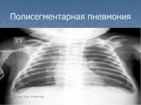 МИНЗДРАВ РА: КРАСНОДАРСКИЕ МЕДИКИ ДИАГНОСТИРОВАЛИ У БЖАНИЯ ДВУХСТОРОННЮЮ ПОЛИСЕГМЕНТАРНУЮ ПНЕВМОНИЮ